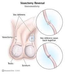 Reviving Dreams: Vasectomy Reversal Clinics in Regina post thumbnail image