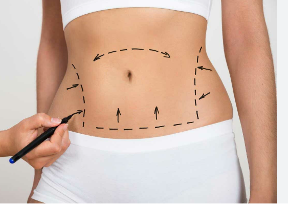 Top Tummy Tuck Techniques Used by Miami’s Cosmetic Surgeons post thumbnail image